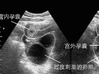 天津市第一中心医院做试管婴儿，专业与费用的全面解析